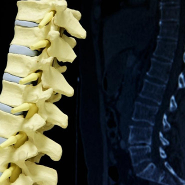 Cirurgia da Coluna